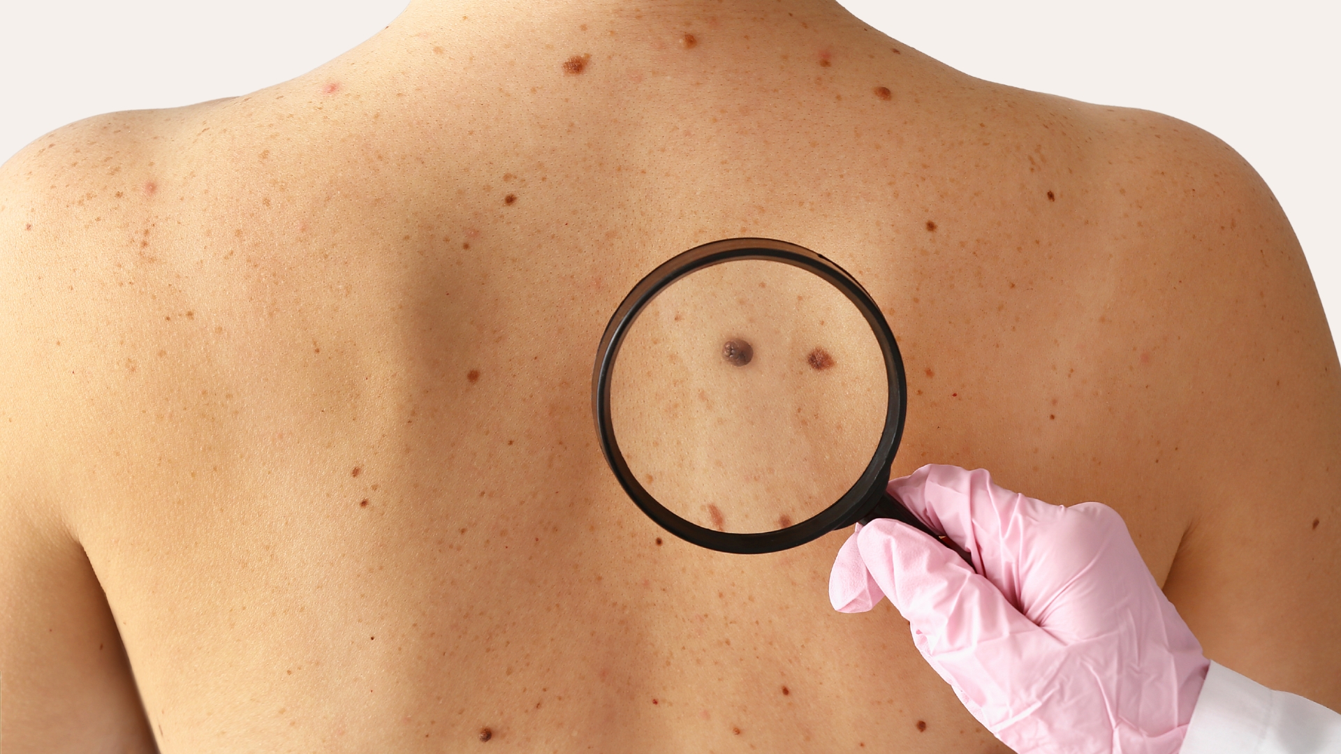 Dermatologist examining moles on a back with a magnifier