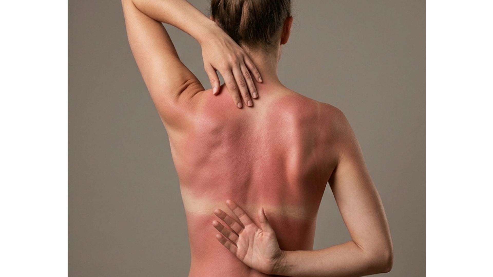 Sunburn pattern on a woman's back